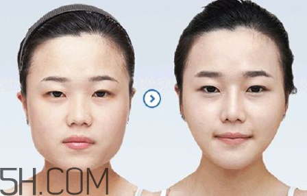 打瘦臉針可以抽煙嗎？打瘦臉針會(huì)反彈嗎？