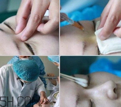 玻尿酸多少錢一支？打玻尿酸有危害嗎？