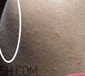 水楊酸可以去黑頭嗎？水楊酸可以去閉口嗎