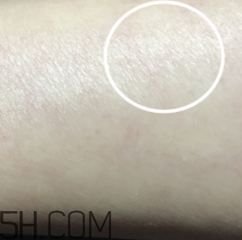 水楊酸可以去黑頭嗎？水楊酸可以去閉口嗎