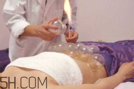 腹部拔罐可以減肥嗎？腹部拔罐拔哪個位置？