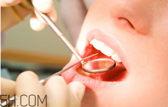 洗牙出血是正常嗎？洗牙后多久可以吃東西？