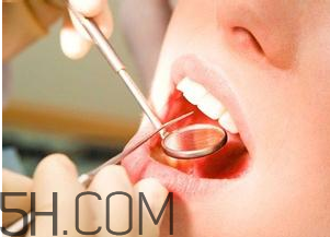 洗牙對牙齒好嗎？洗牙的6大誤區(qū)