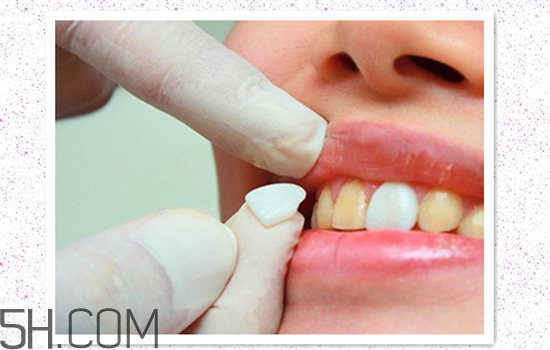 超聲波洗牙可以美白牙齒嗎？超聲波洗牙多少錢一次？