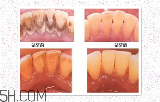 超聲波洗牙可以美白牙齒嗎？超聲波洗牙多少錢一次？