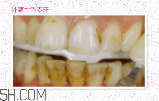 超聲波洗牙可以美白牙齒嗎？超聲波洗牙多少錢一次？