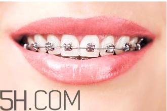 補(bǔ)牙需要帶牙套嗎？補(bǔ)牙后要裝牙套多少錢(qián)？