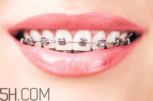 戴牙套可以懷孕嗎？牙齒矯正的后遺癥