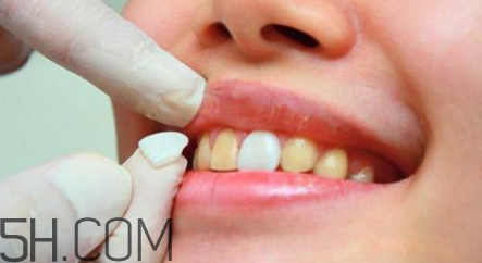 烤瓷牙取下來還能用嗎？瓷貼面美白對(duì)牙齒有損害嗎？