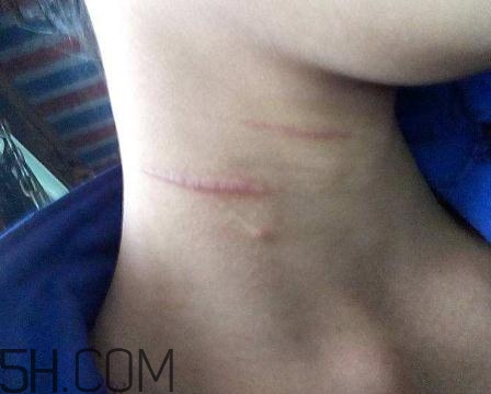 密麗除疤膏怎么用？密麗除疤膏什么時(shí)候用？