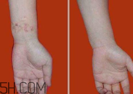 密麗除疤膏效果怎么樣？密麗除疤膏效果對(duì)比照