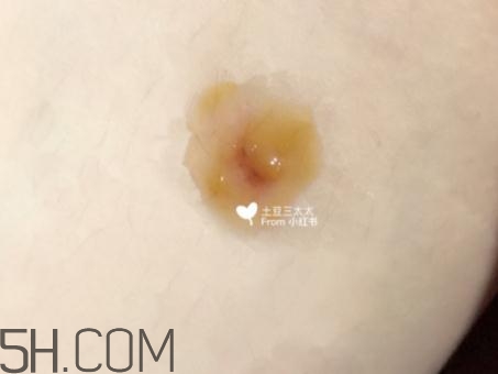 美寶濕潤(rùn)燒傷膏怎么樣？美寶濕潤(rùn)燒傷膏有用嗎？