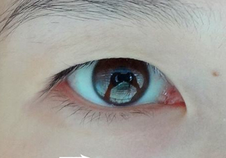 為什么會長脂肪粒？怎么消除眼睛上的脂肪粒？