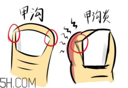 為什么容易得甲溝炎？怎么根治甲溝炎？