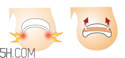 為什么容易得甲溝炎？怎么根治甲溝炎？