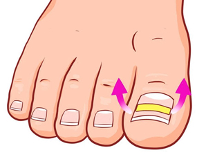 為什么容易得甲溝炎？怎么根治甲溝炎？