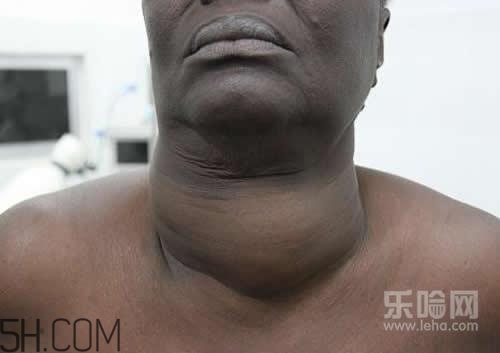 甲狀腺腫大和甲亢的區(qū)別有哪些？甲狀腺腫大適合吃什么食物？