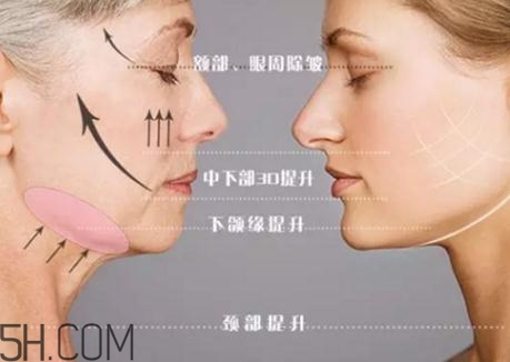 大v線提升有副作用嗎？大v線和小v線的區(qū)別