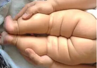 寶寶腿紋不對稱是怎么回事？嬰幼兒的生長發(fā)育標(biāo)準(zhǔn)是怎樣的？