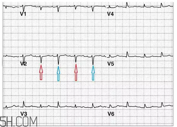 心電圖怎么看？6種常見心電圖異常情況