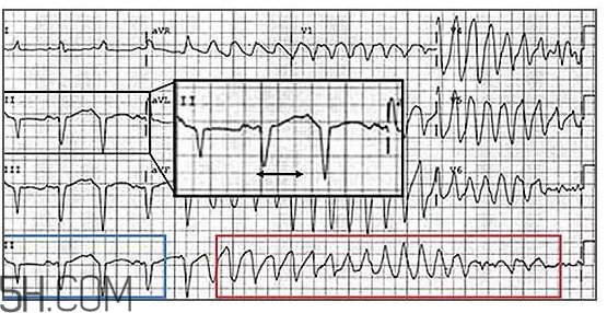 心電圖怎么看？6種常見心電圖異常情況