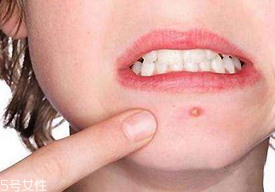 下巴起痘怎么辦？超好用祛痘辦法分享