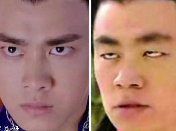 死魚眼怎么治？割雙眼皮可以治死魚眼