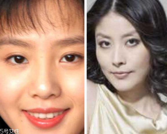 死魚眼怎么治？割雙眼皮可以治死魚眼