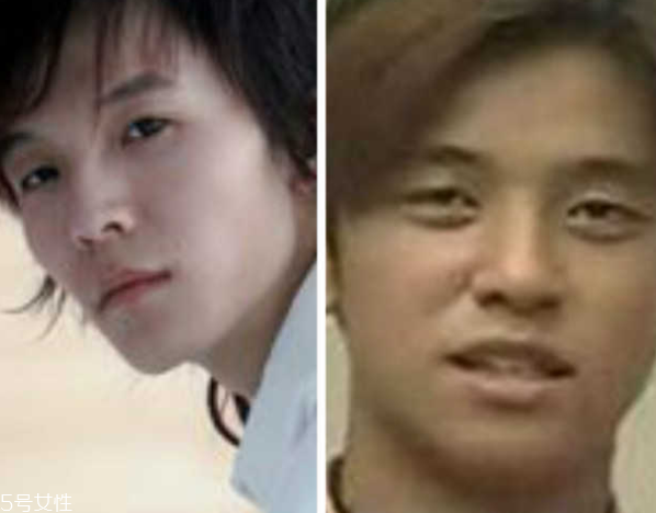 死魚眼怎么治？割雙眼皮可以治死魚眼