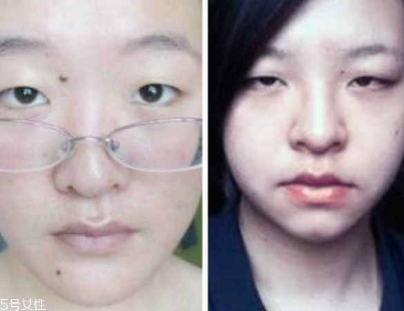 死魚眼怎么治？割雙眼皮可以治死魚眼