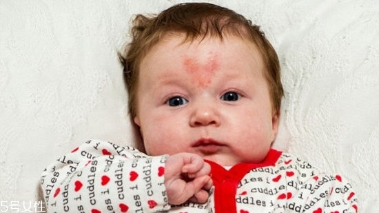 寶寶胎記會(huì)自動(dòng)消失嗎？不同胎記消失情況不同