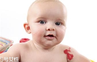 寶寶胎記會(huì)自動(dòng)消失嗎？不同胎記消失情況不同