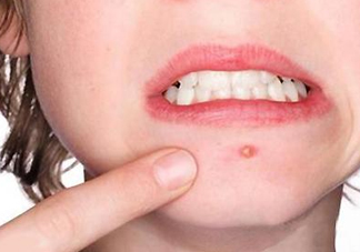 下巴起痘怎么辦？超好用祛痘辦法分享