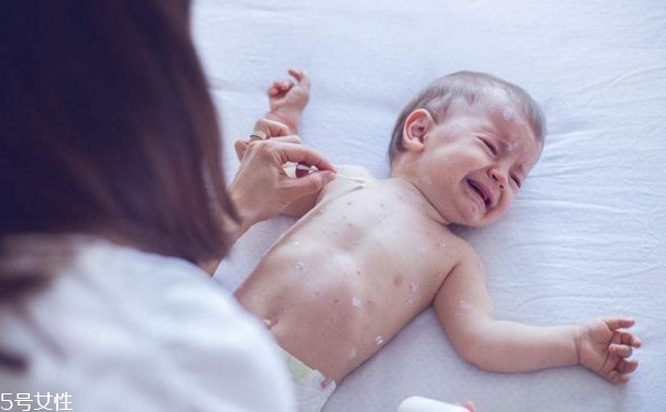 水痘有何傳播途徑？多發(fā)于春秋季