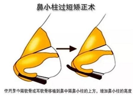 鼻小柱延長用什么材料？優(yōu)先選擇鼻中隔軟骨