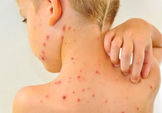 水痘有何傳播途徑？多發(fā)于春秋季