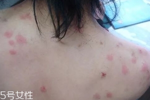 螨蟲有哪些危害？嚴(yán)重時肌膚糜爛