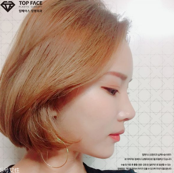 韓國人最愛整哪兒？韓國整形部位TOP4