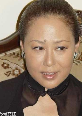 痣能摳掉嗎？這幾種痣摳掉會(huì)成瘤