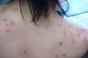 螨蟲有哪些危害？嚴(yán)重時(shí)肌膚糜爛