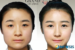 韓國人最愛整哪兒？韓國整形部位TOP4