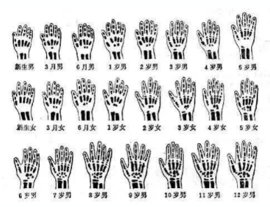 哪些人需要測骨齡？長太快警惕骨齡提前
