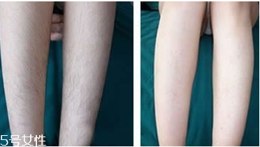 激光脫毛有哪些原理？激光脫毛后護(hù)理小貼士