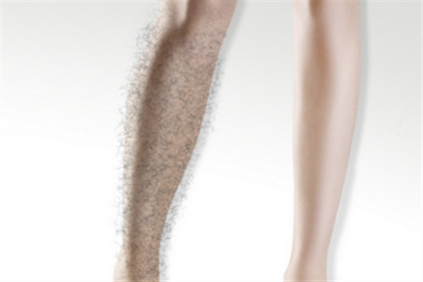 激光脫毛有哪些優(yōu)勢？激光脫毛的方式