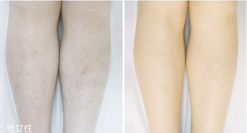 激光脫毛手術后怎么護理？激光脫毛一定要做好防曬