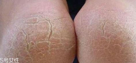 冬天裂腳怎么辦？5招緩解裂腳