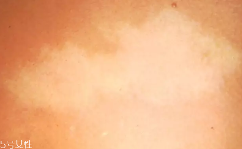 痣什么情況下會(huì)轉(zhuǎn)變?yōu)榱?？點(diǎn)痣不可取