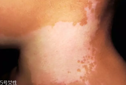 痣什么情況下會(huì)轉(zhuǎn)變?yōu)榱?？點(diǎn)痣不可取