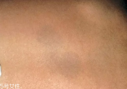 痣什么情況下會(huì)轉(zhuǎn)變?yōu)榱?？點(diǎn)痣不可取