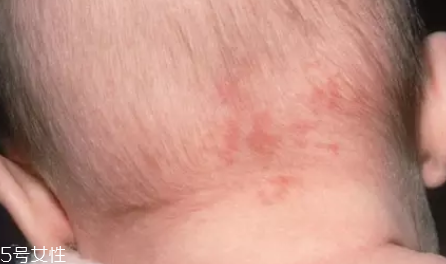 痣什么情況下會(huì)轉(zhuǎn)變?yōu)榱?？點(diǎn)痣不可取